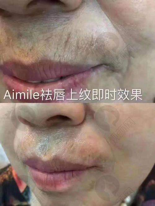 口周注射玻尿酸,依据情况选对支数,开启年轻之旅!
