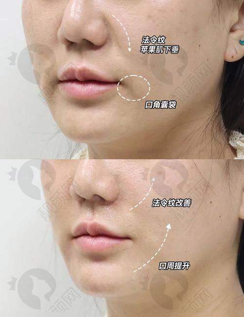 小分子玻尿酸,口周注射几支能实现年轻化?