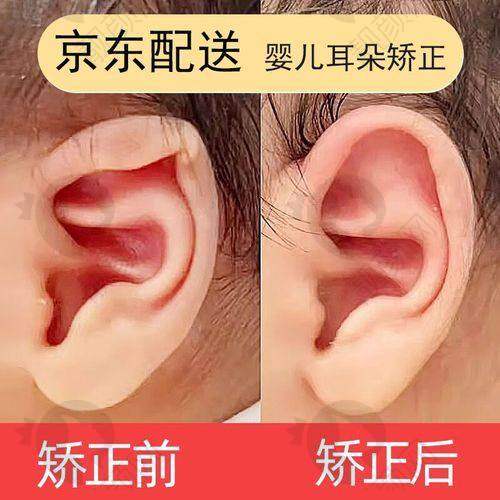 郭志华小耳畸形矫正实例