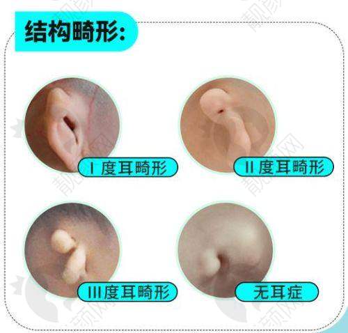 想知道张正文做小耳再造技术咋样?技术优势大揭秘