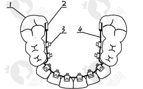 池州安美口腔陶伟伟医生做金属自锁托槽矫正8999元起,数字化正畸清晰直观!