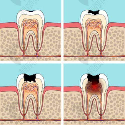 武汉德韩口腔儿童龋齿治疗300元起，数字化正畸技术护航孩子牙齿健康 