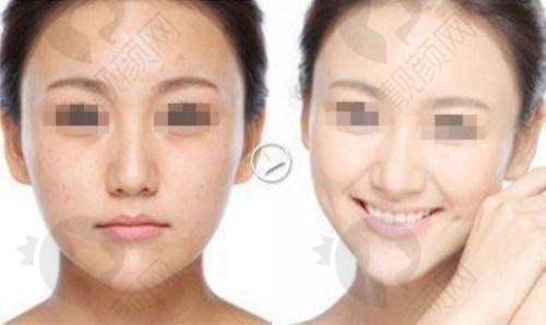 深圳福雅医疗做人中:价格8800元起的高性价比