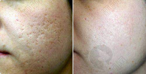 昆明艺星整形医院隆鼻项目:价格多样技术优