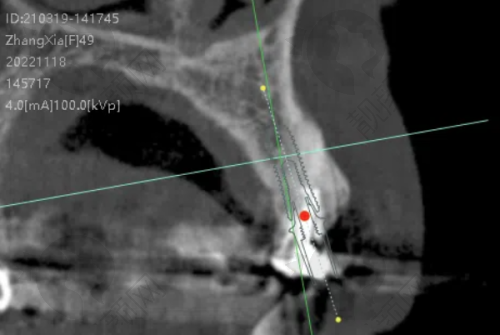 南宁种植牙医院排名前十：种牙便宜又好的柏乐、蓝天等，技术靠谱口碑佳