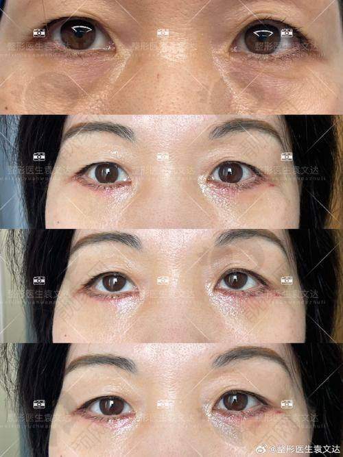 哈尔滨去眼袋好的医院中，瑞丽、艺星、双燕等技术靠谱，口碑与价格优势超诱人！