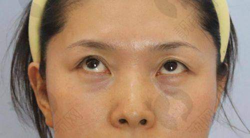 哈尔滨去眼袋好的医院中,艺星医疗美容医院技术靠谱,口碑与价格优势超诱人!