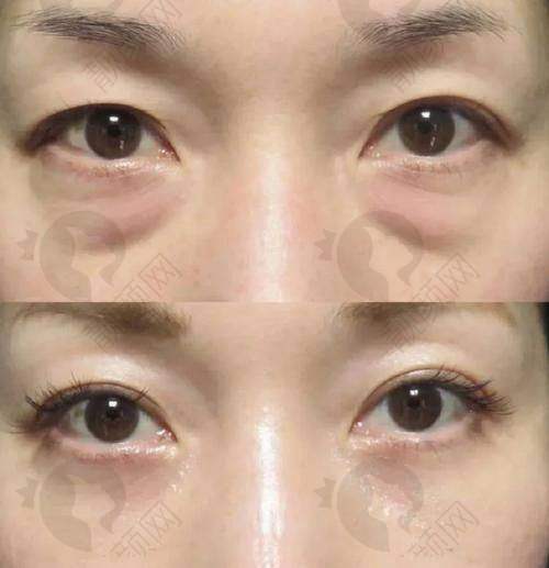 哈尔滨去眼袋好的医院中,双燕医疗美容门诊部技术靠谱,口碑与价格优势超诱人!