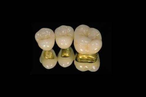 武汉德韩口腔钴铬合金烤瓷冠价格680元起，连锁品牌技术优，镶牙服务超贴心 