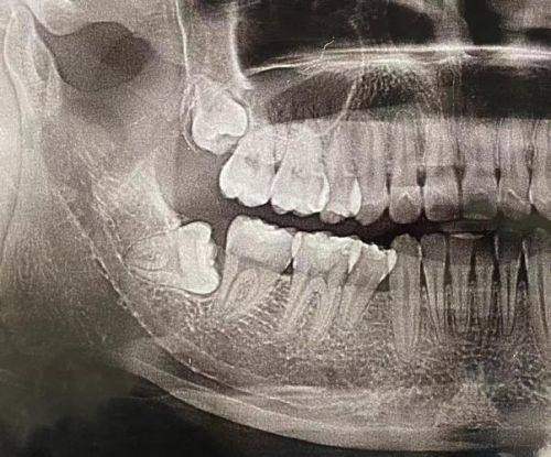 池州安美口腔医生做阻生智齿拔除价格188元起，每月优惠活动让看牙更划算 