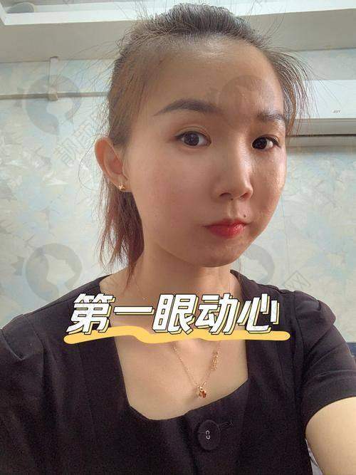 北京美莱医疗美容医院张颖做全切双眼皮价格8000元起，航天级技术缔造灵动美眼 