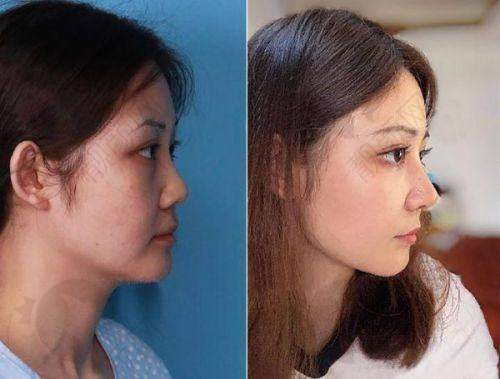 北京美莱医疗美容医院隆鼻医生王旭东介绍