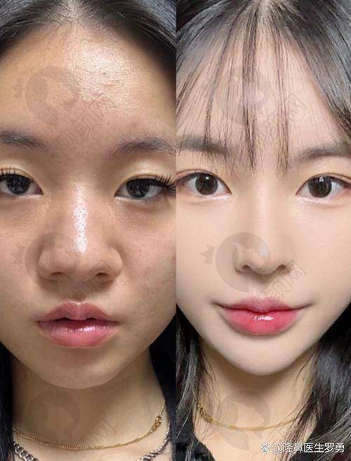 北京美莱医疗美容医院王旭东做韩式生科隆鼻10000元起，打造宛如天生自然鼻型！ 
