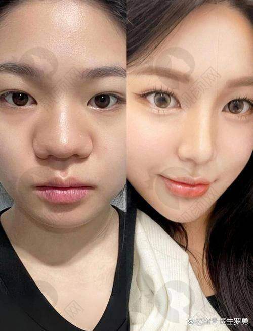 合肥隆鼻医生排名前十榜单公布!华美、艺星等医院技术靠谱,口碑超赞别错过